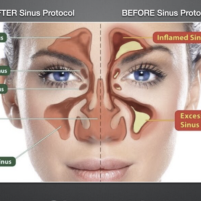 SINUS PROTOCOL